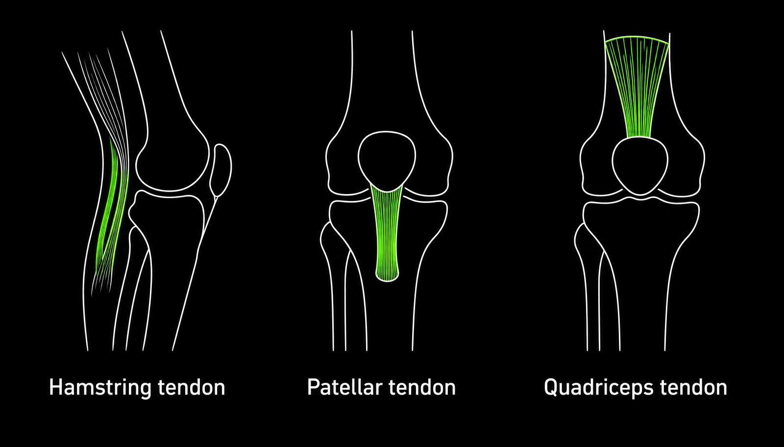 Comparison diagram showing hamstring, patellar tendon and quadriceps tendon graft sites in the knee