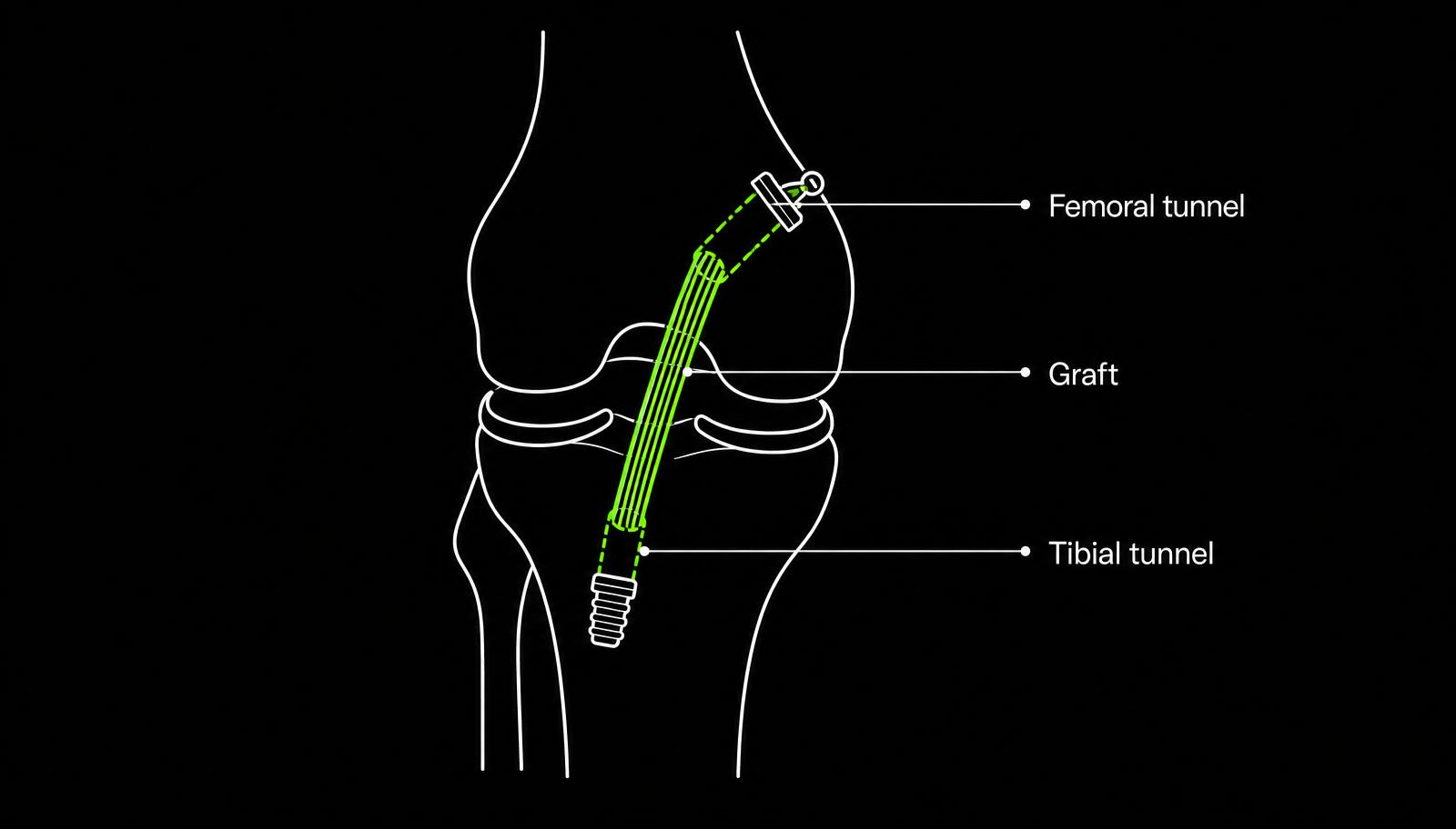 Diagram showing a reconstructed anterior cruciate ligament graft passing through tunnels in the thigh bone and shin bone