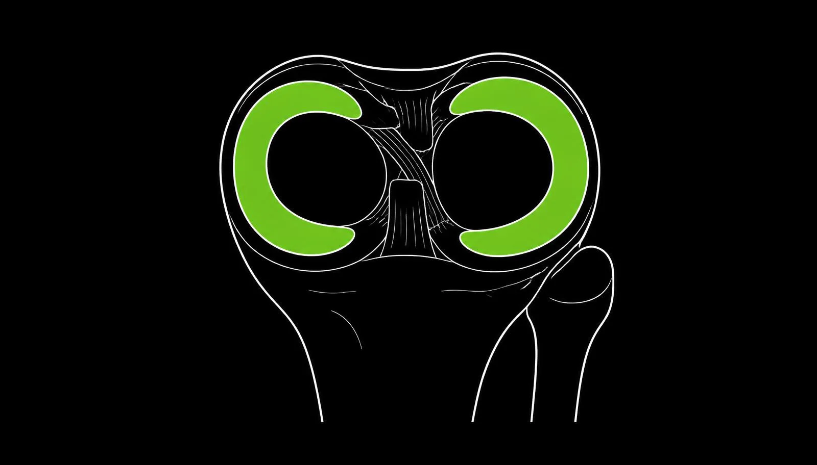 Line drawing of the top of the shin bone viewed from above with the two C-shaped meniscus wedges filled in bright green