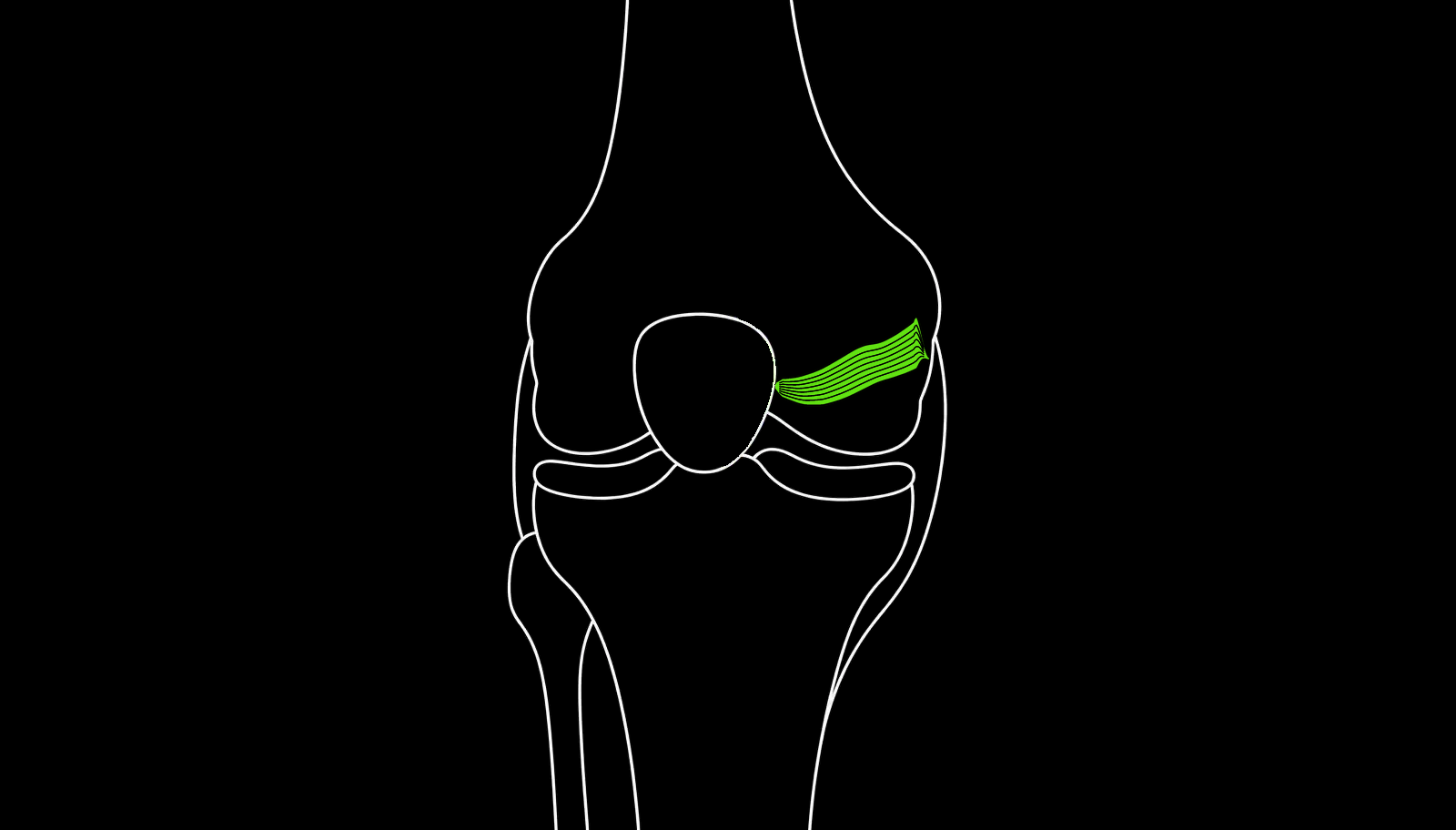 Line drawing of a knee showing a green tendon graft running from the inner edge of the kneecap to a fixation point on the thigh bone