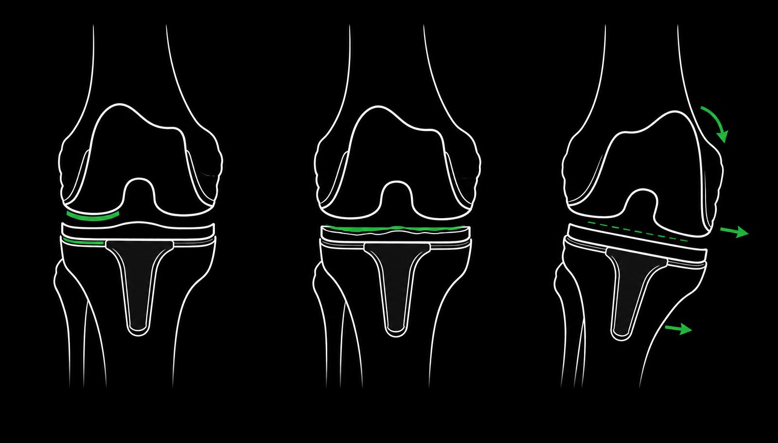 Diagram showing three ways a knee replacement fails: loosening of the implant, a worn bearing, and instability of the components