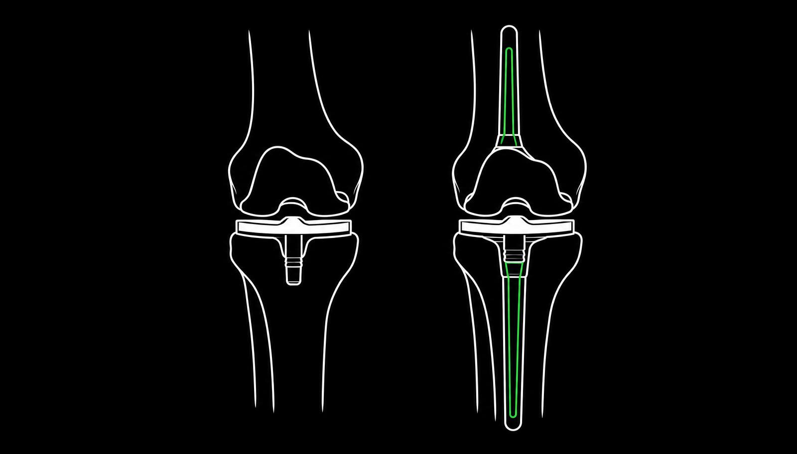 Comparison diagram showing a primary knee replacement beside a revision knee replacement with longer stems extending into the bone