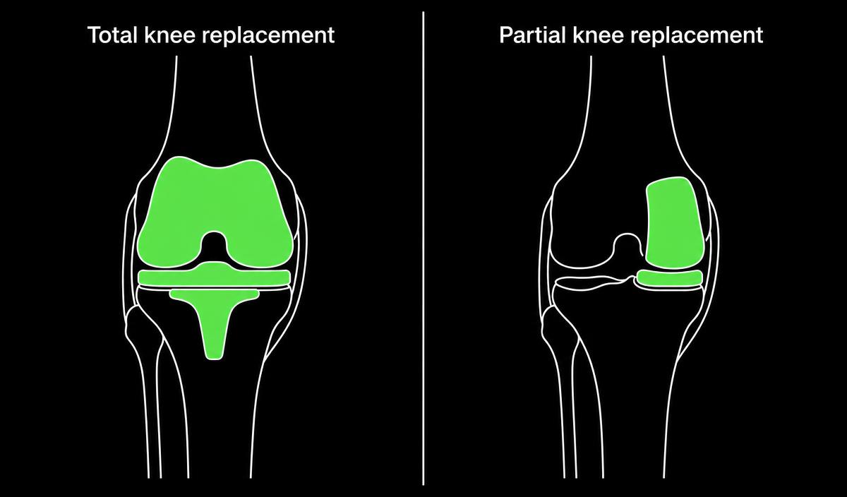 Side-by-side diagram comparing a total knee replacement with a partial knee replacement